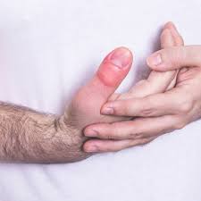 Image result for Hand Injury