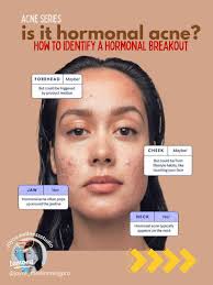 Flatten cystic acne in just 3 days! JB Clinic~