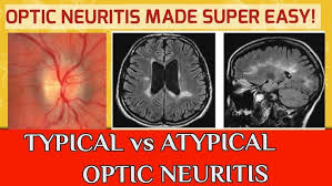 Image result for Optic Neuritis