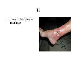 Obvious change in a wart or mole. Caution 7 Warning Signs That You Should Have Examined By A Doctor Ppt Download