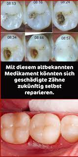 Mit Diesem Altbekannten Medikament Konnten Sich Geschadigte Zahne Zukunftig Selbst Reparieren Oral Health Care Health Tips Healthy Skin Care