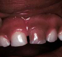 If it takes more than a twist or two, the tooth may not be ready to come out. Oh No My Child S Tooth Is Turning Dark Jean Chan D D S Associates