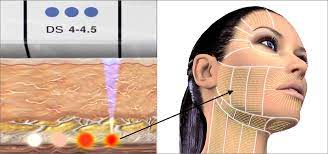 The use of ultrasound energy boosts your own natural production. Science Behind Ultrasound Skin Lift Treatments Ultherapy