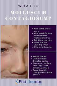 Or, you can head straight to the bottom to find out how we got rid of molluscum contagiosum fast with an oral medication from our pediatrician and an all natural ointment! What Is Molluscum Contagiosum Treatment And Home Remedies