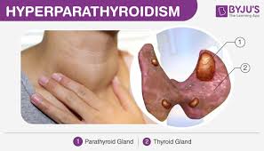 Image result for Hyperparathyroidism