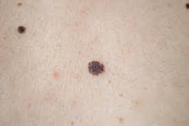 Melanoma is a serious type of cancer of … The Types Of Skin Cancer