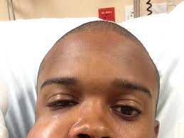 A scary incident that took place on friday, when the righty was belted on the upper right side of his face by a line drive while he was throwing in a simulated game in fort myers, fla. Baseball Player Hit In Face With Fastball Pic