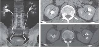 Image result for Nephrolithiasis Imaging