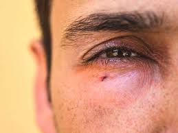 Learn more about vsp's nationwide network of eye the premier indicator is not meant as a designation of care quality as all of our doctors already meet vsp's high quality standards for professional services. Eye Emergencies Types Symptoms And Prevention
