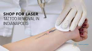 Removery exists to empower you to become who you want to be, by giving you choices over your tattoos. Shop For Laser Tattoo Removal In Indianapolis Indy Laser