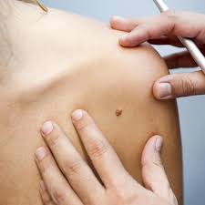 We did not find results for: What Is Seborrheic Keratosis Retief Skin Center Nashville S Best Dermatologist Cosmetic Dermatology Team