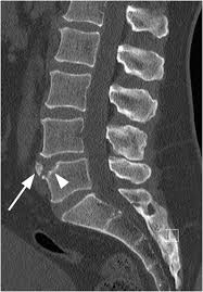 Check spelling or type a new query. Normal Variants And Mimickers Section 1 Clinical Imaging Of Spinal Trauma