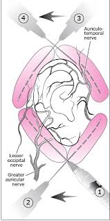 Image result for Ear Nerve Block