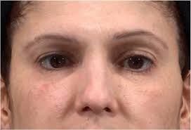 A Prospective, Multicenter, Evaluator-Blind, Randomized, Controlled Study  of Belotero Balance (+), a Hyaluronic Acid Filler With