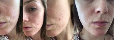 Aber falls du aktive akneherde hast, sollten die erst angegangen werden, bevor du mit vitamin c und retinoiden (vitamin a) gegen pickelmale vorgehst. Eigenbluttherapie Prp Gegen Akne Und Aknenarben Vicky Wanka Fashionblog