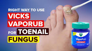 use vicks vaporub for toenail fungus