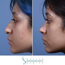 Dr Spencer Cochran (@dallas_rhinoplasty_center) • Instagram photos and  videos