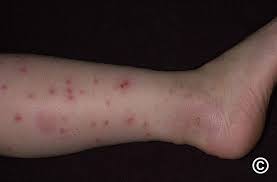 Image result for Papular urticaria