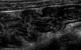Diffuse Thickening Of Bowel Wall In A Patient With Colitis Pelvic Inflammatory Disease Small Bowel Obstruction Large Bowel
