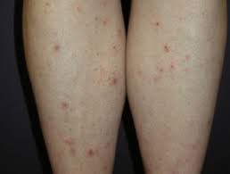 This will open up the pore and kill the bacteria, which makes the bumps redden and more swollen. Shaving Dermnet Nz