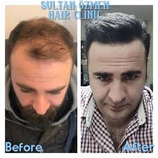 Sultan Özmen Hair Clinic in Bagcilar, Istanbul • Read 14 Reviews