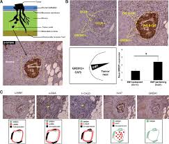 What is it and how is it diagnosed? Bone Morphogenetic Protein Antagonist Gremlin 1 Regulates Colon Cancer Progression