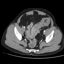 Maybe you would like to learn more about one of these? Sigmoid Colocolic Intussusception Radiology Case Radiopaedia Org