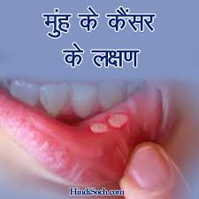 Oral cancer affects the lips, gums, tongue, roof of the mouth, insides of the cheeks, or the soft floor of the mouth under the tongue. à¤® à¤¹ à¤• à¤• à¤¸à¤° à¤• à¤²à¤• à¤·à¤£ à¤µ à¤• à¤°à¤£ Mouth Cancer Symptoms In Hindi