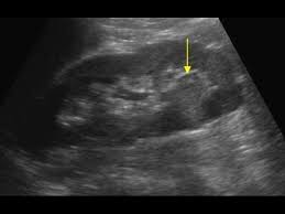Ultrasound Renal Cell Carcinoma