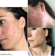 Laser Facial Side Effects And Risks Laser Facial Facial Interesting Faces