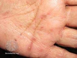 Image result for scabies human bites