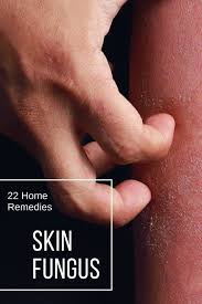 Home Remedies To Get Rid Of Skin Fungus Home Remedies For Ringworm Fungal Infection Skin Home Remedies For Skin