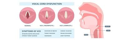 Image result for Vocal Cord Dysfunction