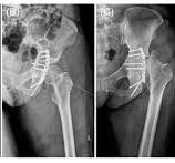 Anatomical Posterior Acetabular Plate Versus Conventional ...