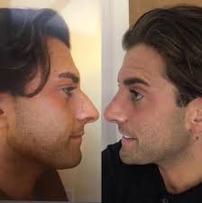 Furthermore, if you want a celebrity male rhinoplasty you should be prepared to pay more than $10,000. The Best And Worst Celebrity Nose Jobs From Ferne Mccann To Rebecca Adlington And La Toya Jackson