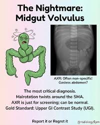 Image result for Midgut Volvulus