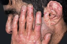 Image result for Physotrichia