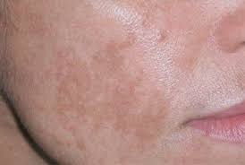 Comment se protéger du masque de grossesse ? Masque De Grossesse Description Prevention Et Traitements
