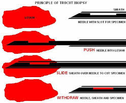 Liquid biopsy provides the opportunity of detecting, analyzing and monitoring cancer in various body effluents such as blood or urine instead of a fragment of cancer tissue. Biopsy Principles Pathology Orthobullets