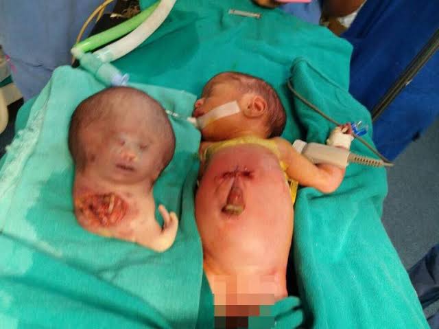 Mga resulta ng larawan para sa Parasitic Twins"