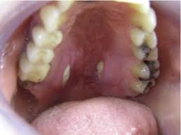 Check spelling or type a new query. The Clinical Histologic And Treatment Spectrum In Necrotizing Sialometaplasia Oral Surgery Oral Medicine Oral Pathology And Oral Radiology