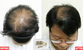 Can hair miniaturization be reversed? Scientists Claim To Have Found An Extract From Mangrove Trees That Can Cure Baldness Daily Mail Online
