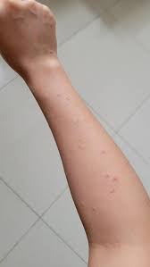 Image result for scabies bite