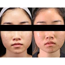 There's a variety of scar treatment options. Melbourne Acne Scarring Laser Treatment Which Is The Best Procedure