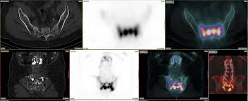 Use Of Spect Ct With 99mtc Mdp Bone Scintigraphy To Diagnose Sacral Insufficiency Fracture Journal Of Nuclear Medicine Technology