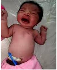 An unusual case of a neonate with left sided type 3 poland syndrome with  dextrocardia