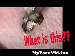 Disgusting Popping Pimples Videos - Free Porn Videos