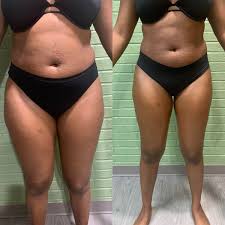 Browse through the before and after airsculpt® transformations that interest you. Wood Therapy Skin Care Spa Spa Studio