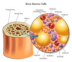 How to detect ovarian cancer early. How Multiple Myeloma Of The Spine Is Diagnosed