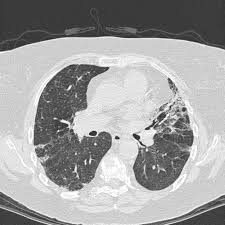 Systemic Lupus Erythematosus And Antiphospholipid Antibody Syndrome Clinics In Chest Medicine